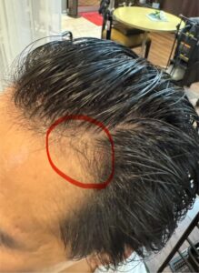 【育毛促進メニュー】お客様の実例①